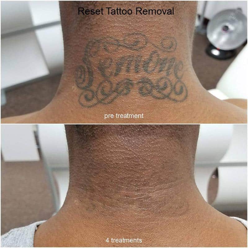 Reset Tattoo Removal